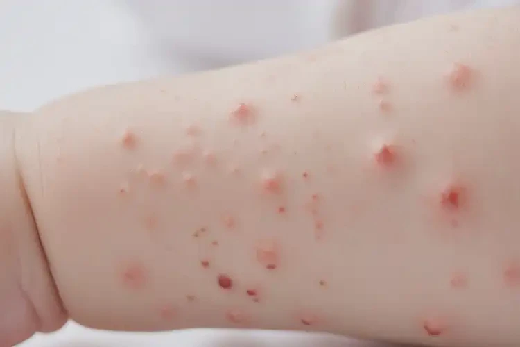 嬰幼兒手臂上起濕疹能靠自己自愈嗎(圖4)