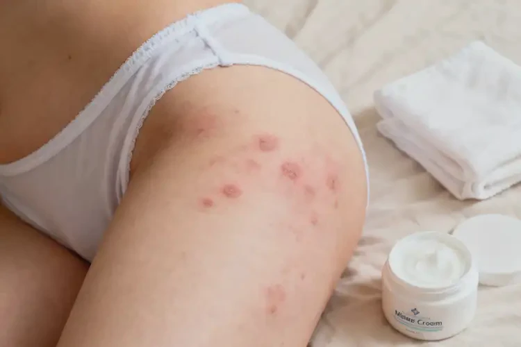 女生屁股上有濕疹不管它會(huì)自己好嗎(圖1)