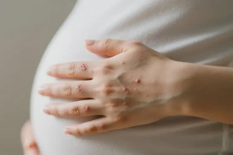 孕婦手上偶爾起濕疹不管它會(huì)自己自愈嗎(圖4)
