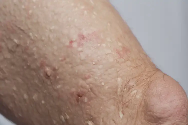 老人大腿有濕疹能夠徹底治愈嗎(圖4)