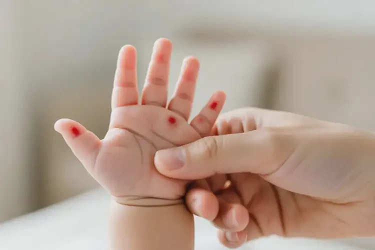 寶寶手上有濕疹不管它會自己好嗎(圖3)