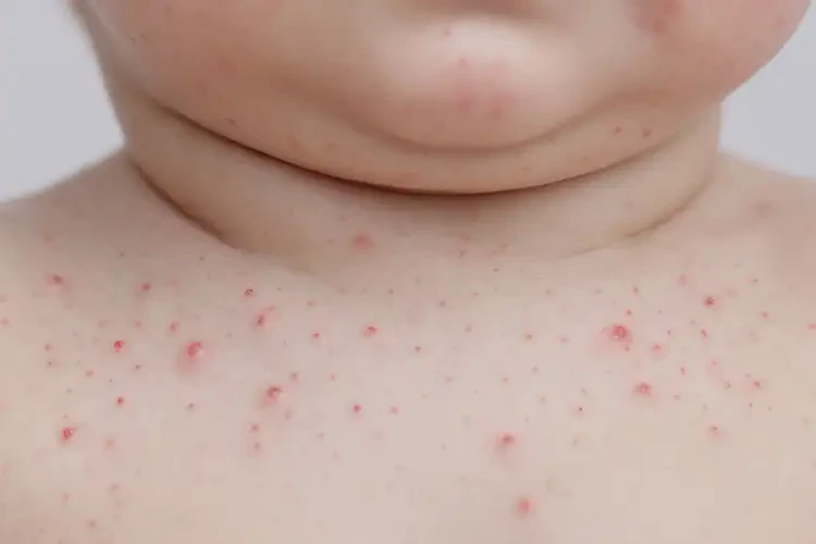 嬰兒脖子上長濕疹可不可以徹底自愈(圖4)