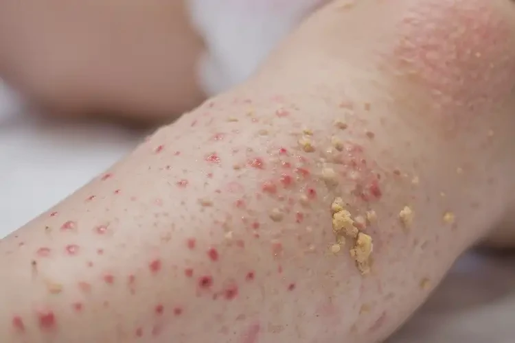 幼兒小腿偶爾起濕疹能靠自己自愈嗎(圖2)