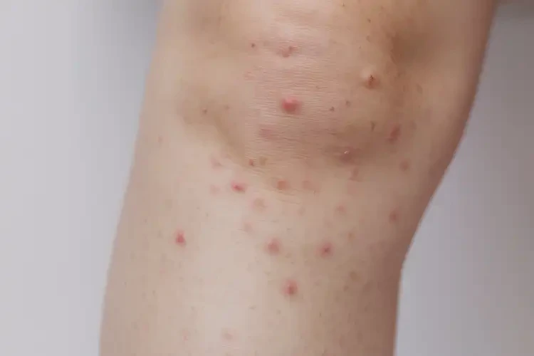 孩子小腿起湿疹可不可以彻底自愈(图4)