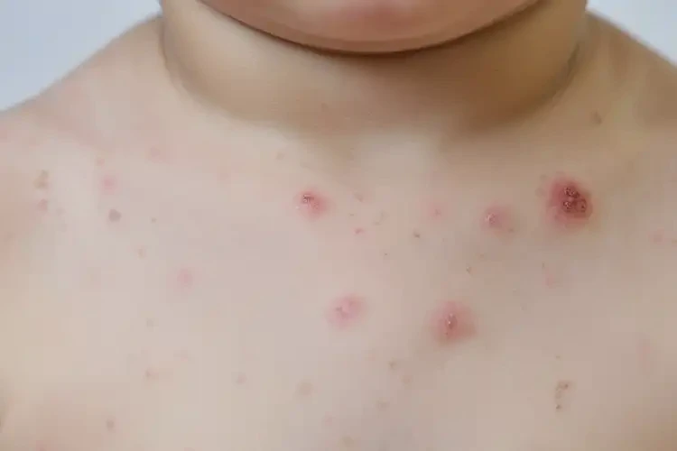 幼兒脖子上偶爾起濕疹能靠自己自愈嗎(圖4)