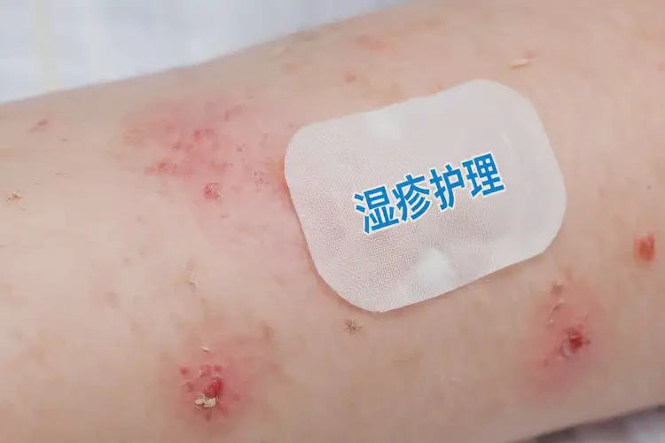 寶寶四肢出濕疹可以徹底自愈嗎(圖4)