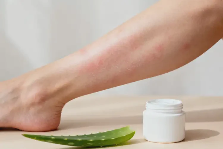 女性手臂出現(xiàn)濕疹可以徹底自愈嗎(圖4)