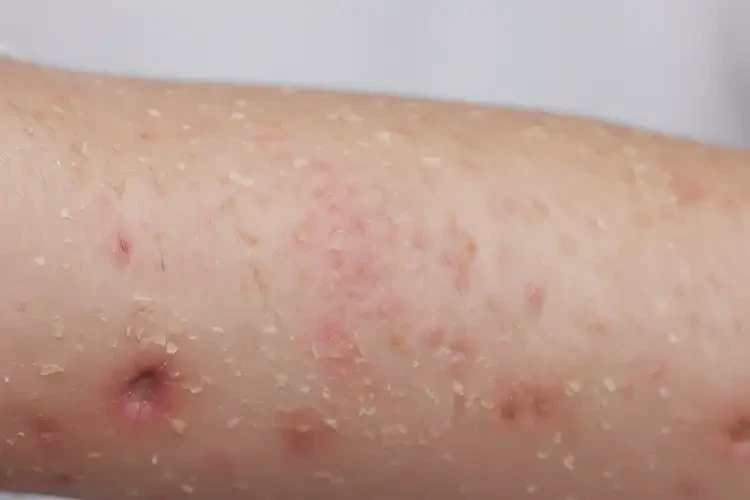 兒童手臂上出現(xiàn)濕疹能徹底自愈嗎(圖4)