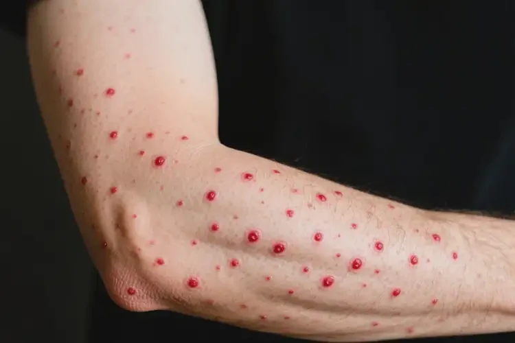 男人手臂上容易长湿疹不管它会自己自愈吗(图1)