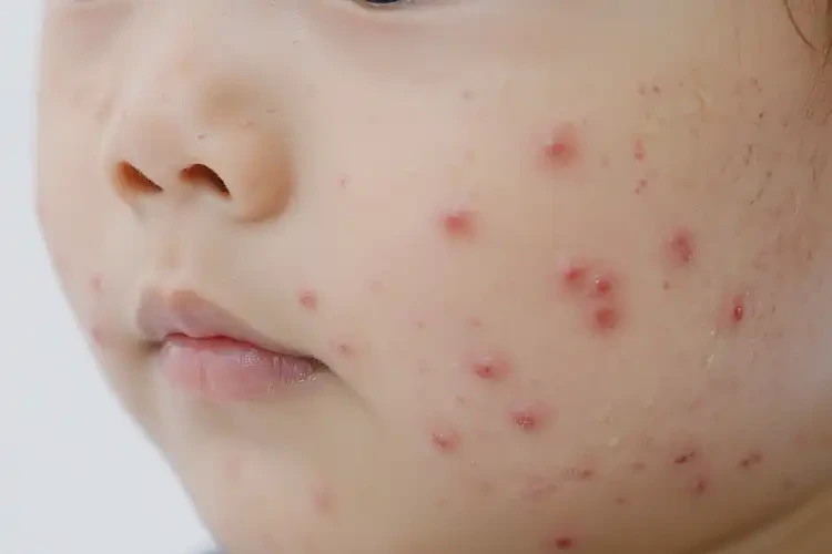 少兒面部偶爾起濕疹能靠自己自愈嗎(圖4)