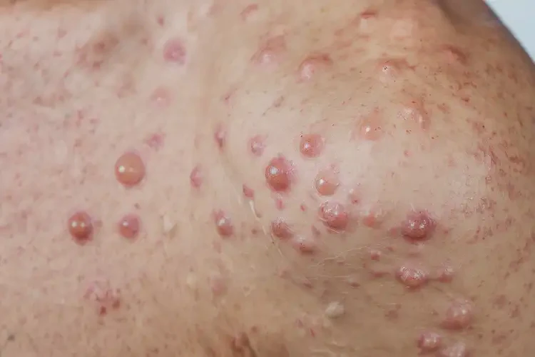 男人全身容易起濕疹可不可以徹底自愈(圖3)