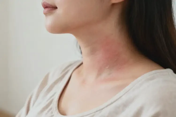 孕婦脖子長濕疹可以徹底自愈嗎(圖1)