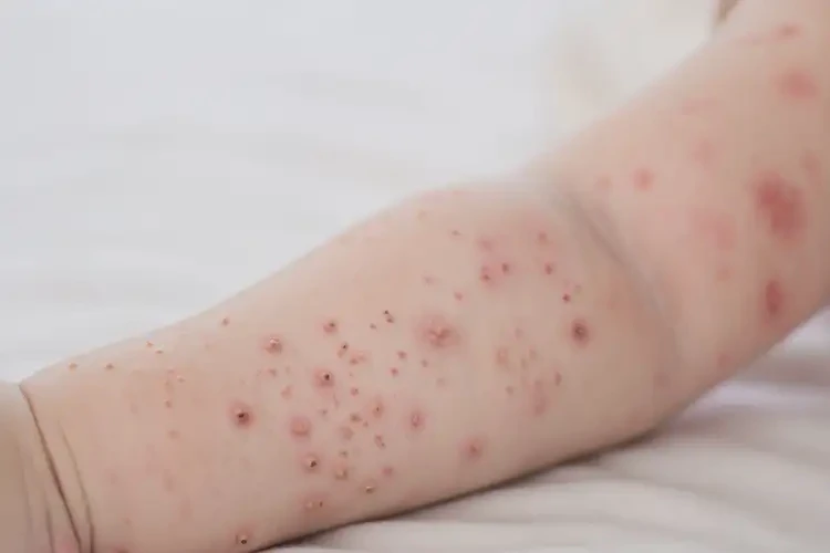 寶寶手臂上經(jīng)常起濕疹不管它會自己好嗎(圖4)