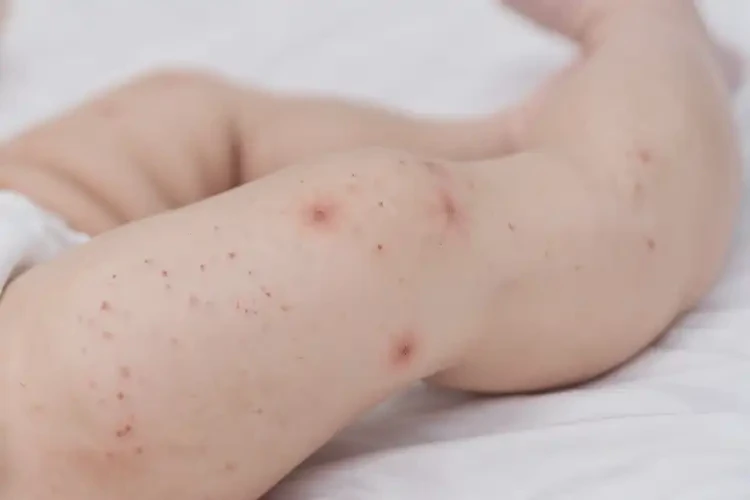 寶寶大腿上長(zhǎng)濕疹可不可以徹底自愈(圖4)