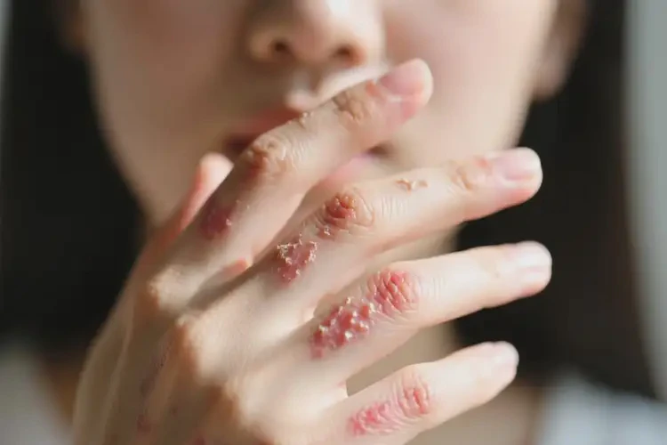 女生手上偶爾長濕疹不管它會自己自愈嗎(圖4)