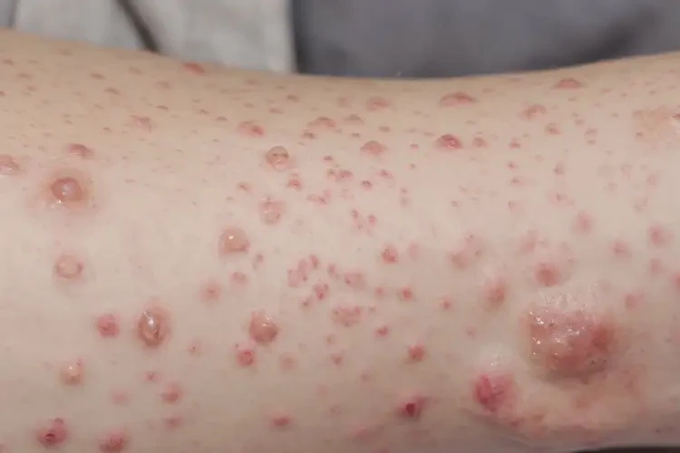 青少年四肢容易起濕疹不管它會(huì)自己好嗎(圖4)