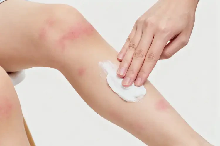 孩子大腿上起濕疹不管它會(huì)自己痊愈嗎(圖3)