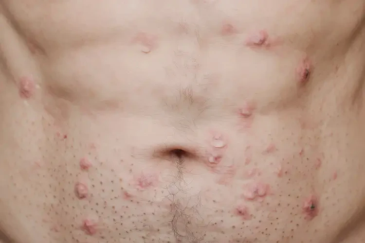 男性肚子上容易起濕疹可以徹底自愈嗎(圖4)