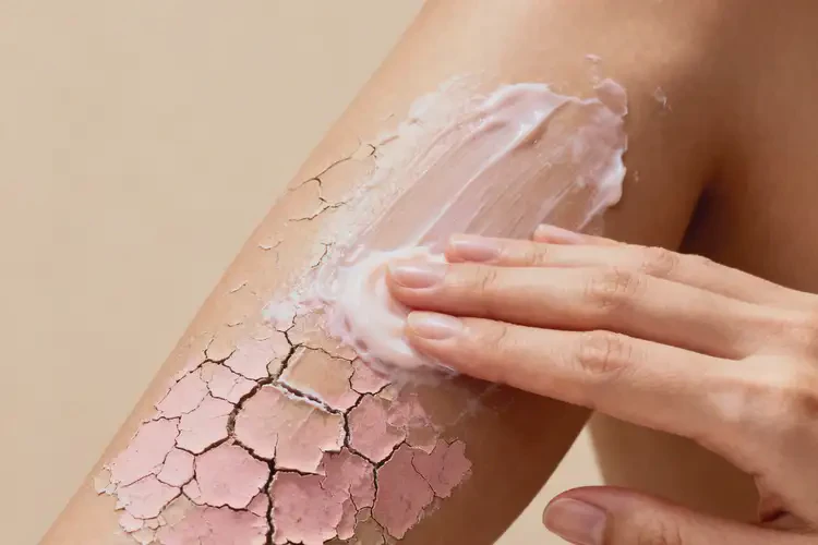 女性全身出湿疹能彻底自愈吗(图3)