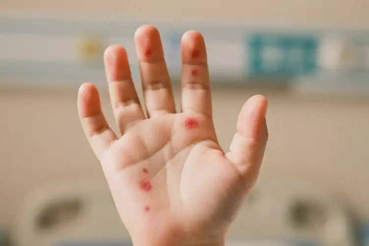 孩子手上偶爾起濕疹不管它會(huì)自己自愈嗎(圖3)