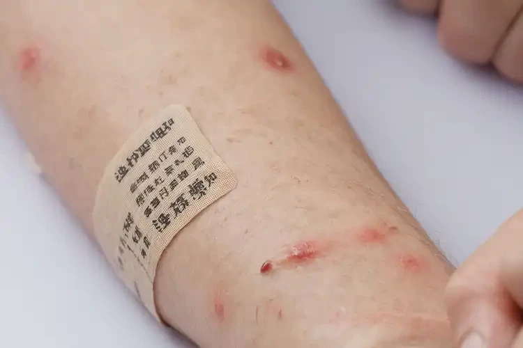 青少年身上經(jīng)常起濕疹能靠自己自愈嗎(圖4)