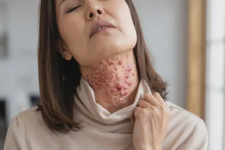 女人脖子出現(xiàn)濕疹可不可以徹底自愈(圖3)