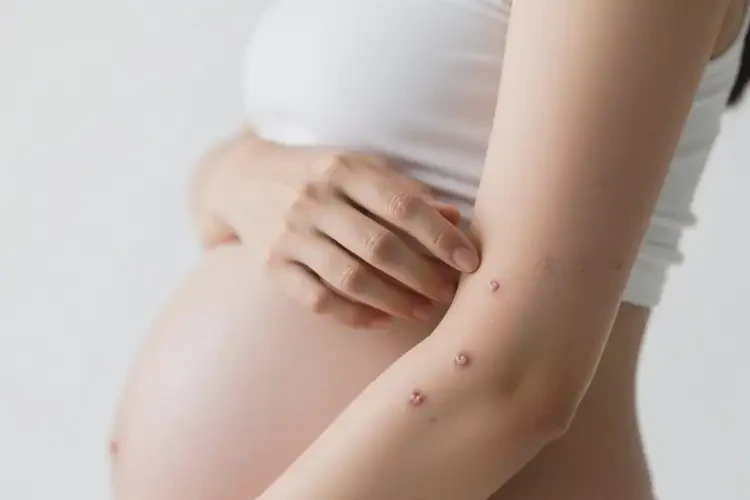 產(chǎn)婦身上偶爾起濕疹可不可以徹底自愈(圖3)