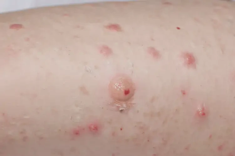 幼兒大腿出濕疹不管它會(huì)自己痊愈嗎(圖4)