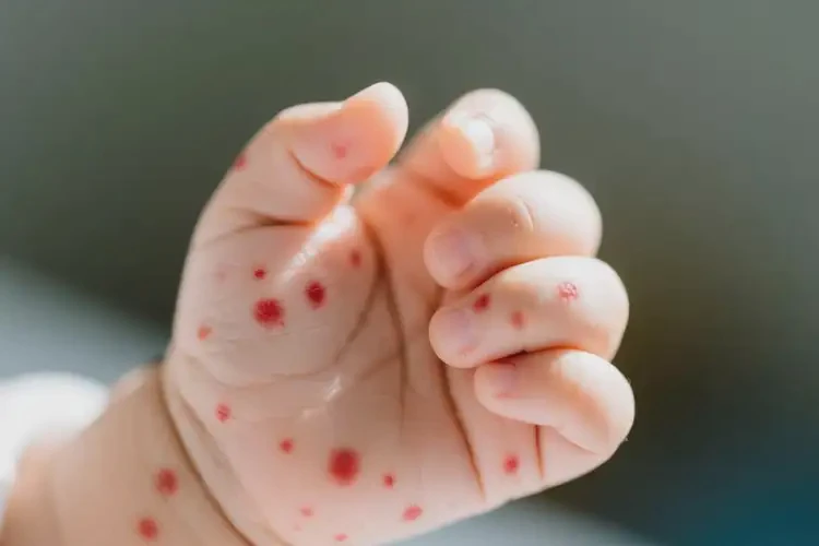 嬰幼兒手上容易起濕疹不管它會(huì)自己好嗎(圖4)