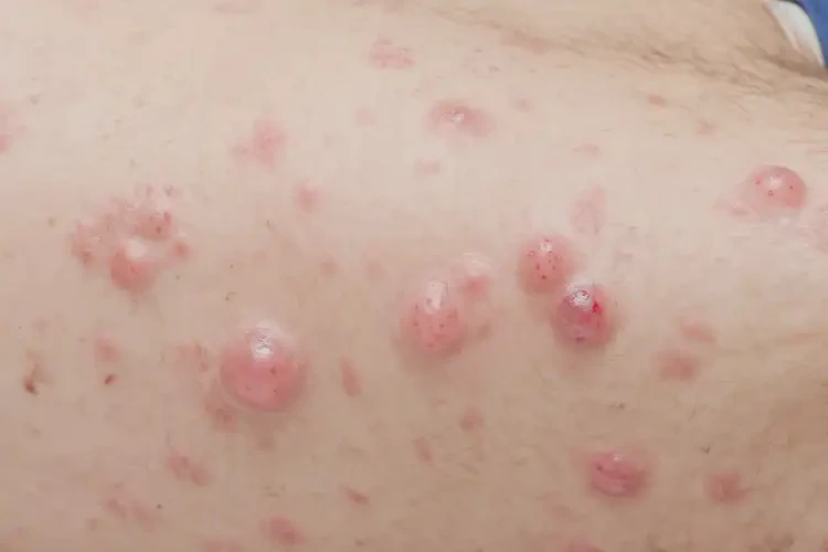 青年人肛周容易起濕疹可不可以徹底自愈(圖4)