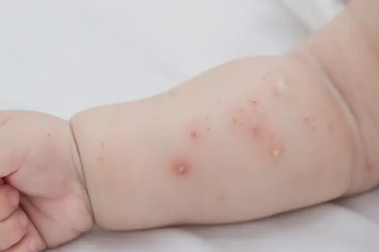 寶寶手臂偶爾長濕疹能靠自己自愈嗎(圖3)