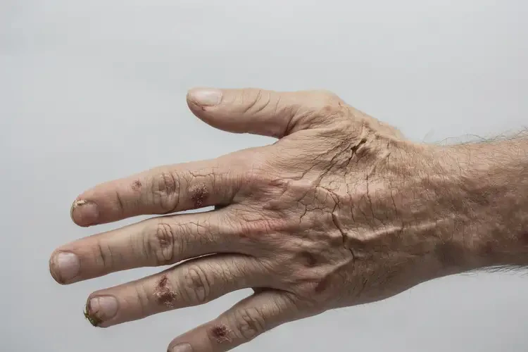 男人手上長濕疹不管它會自己好嗎(圖2)
