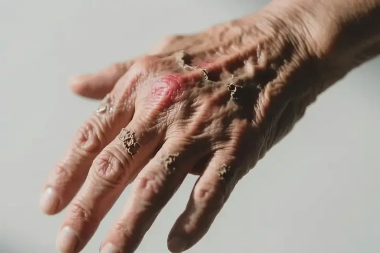 老人手上經(jīng)常起濕疹不管它會(huì)自己痊愈嗎(圖2)