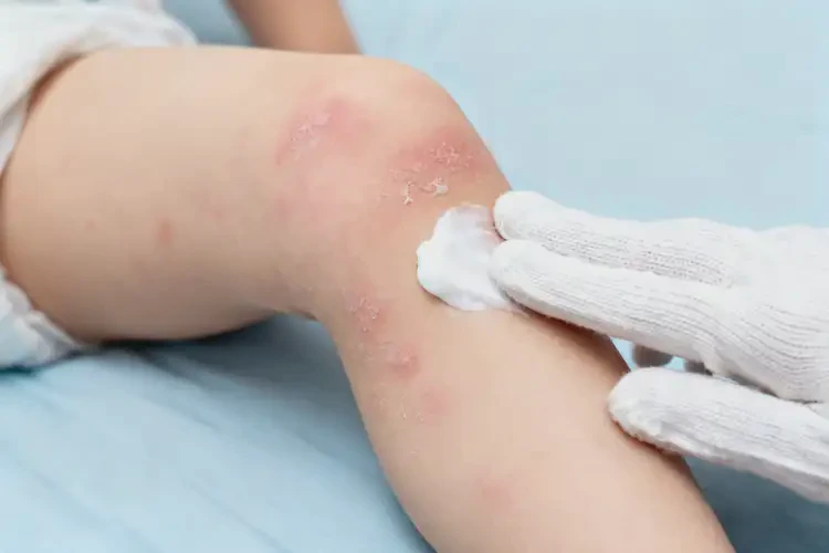 小孩大腿容易長濕疹可不可以徹底自愈(圖1)