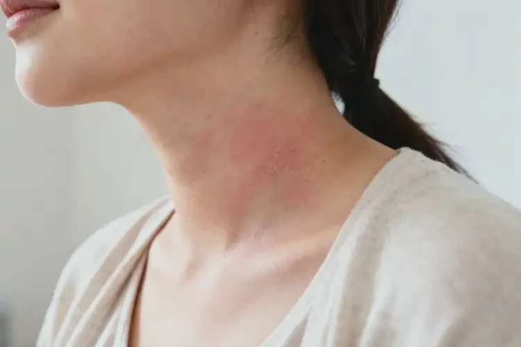 孕婦脖子長濕疹可以徹底自愈嗎(圖4)