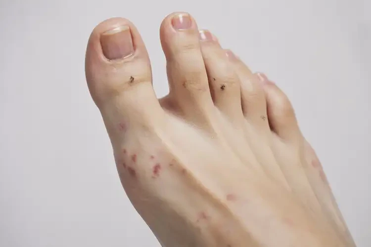 女性腳上長濕疹可不可以徹底自愈(圖4)