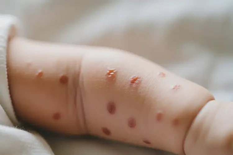 新生兒手臂上偶爾長(zhǎng)濕疹不管它會(huì)自己痊愈嗎(圖2)