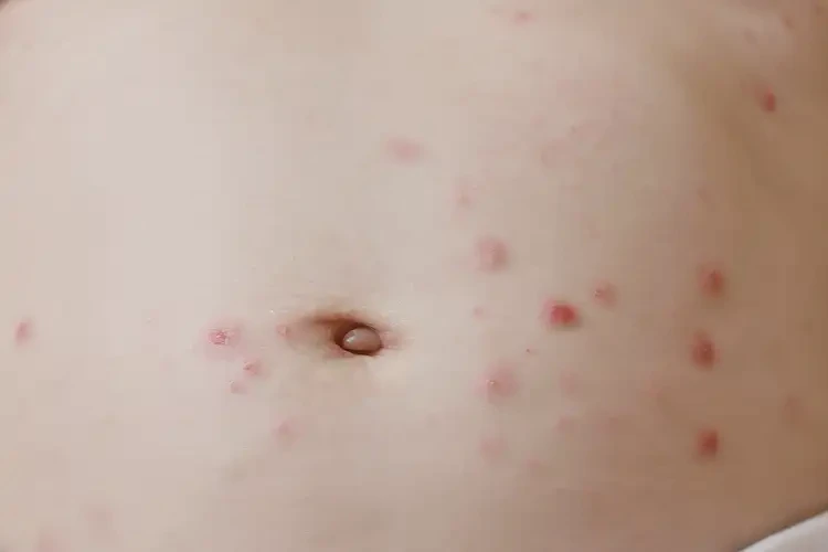 孩子肚子出濕疹不管它會(huì)自己痊愈嗎(圖4)