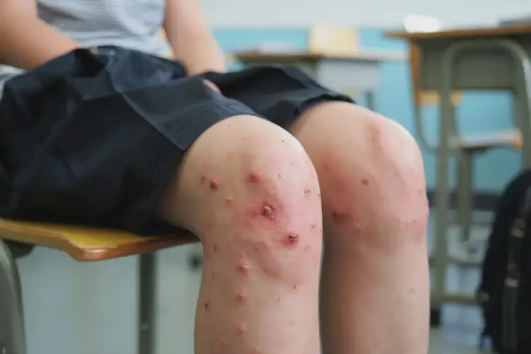 中學(xué)生大腿上起濕疹不管它會(huì)自己自愈嗎(圖4)