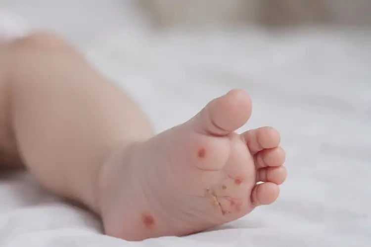 寶寶腳上偶爾長(zhǎng)濕疹不管它會(huì)自己痊愈嗎(圖3)