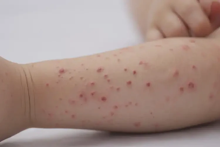 少兒四肢容易起濕疹可以徹底自愈嗎(圖4)