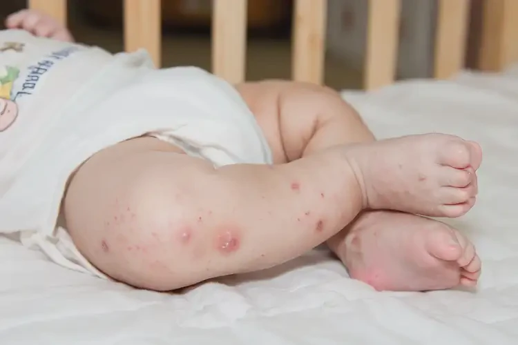 寶寶大腿偶爾長(zhǎng)濕疹不管它會(huì)自己好嗎(圖4)