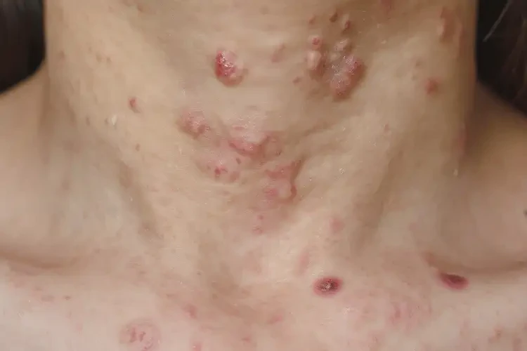 青少年脖子容易起濕疹能不能徹底自愈(圖4)