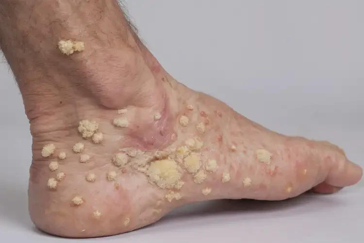 男人腳上偶爾起濕疹不管它會(huì)自己痊愈嗎(圖3)