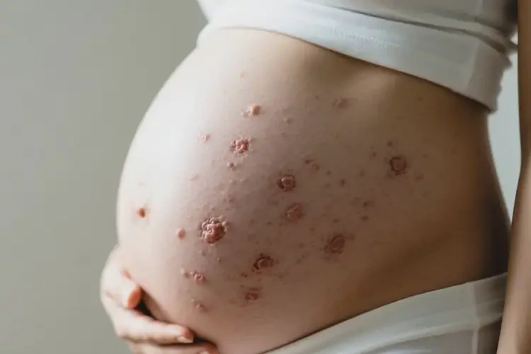 孕婦肚子上出現(xiàn)濕疹不管它會自己痊愈嗎(圖1)
