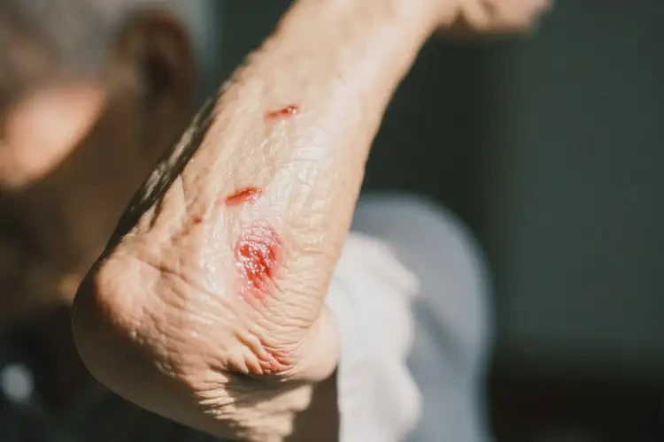 老人手臂上出現(xiàn)濕疹能靠自己自愈嗎(圖2)