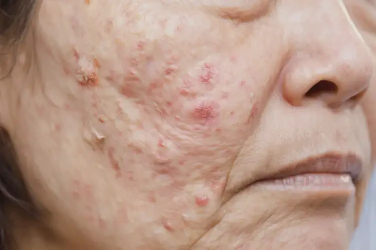 女人屁股上容易起濕疹能不能徹底自愈(圖4)