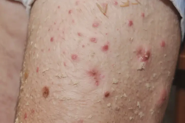 老人大腿上有濕疹可不可以徹底自愈(圖4)