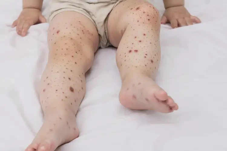 幼兒大腿上容易長濕疹能徹底自愈嗎(圖4)