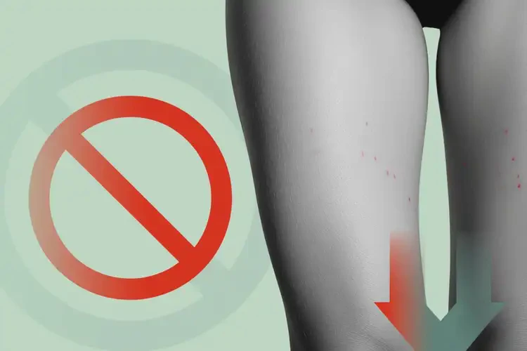 女人大腿容易長濕疹可以徹底自愈嗎(圖1)